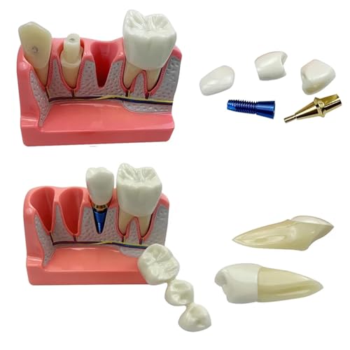Rwbatt DM625 4 Times Dental Implant Model With Removable Crown Bridge Dental Veneers Porcelain Teeth thumb #5