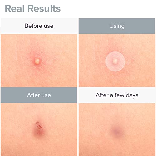 Image of Acne Pimple Patch 57 Units Hydrocolloid Made in Korea 3 Sizes 8mm 10mm 12mm Waterproof Sheet