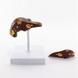 Educational Model Anatomical Model Human Liver Pathology Stone Anatomy Model for Medical School Educational Study Teaching Aids Demonstration Lab Science Equipment,Medical Models