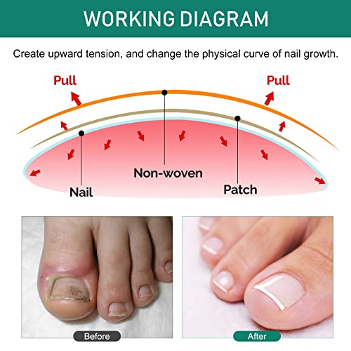 Ingrown Toenail Treatment, Ingrown Toenail Removal Kit With Pedicure Toenail Corrector Patch And Nail Correction Tool, Glue-Free And Painless Ingrown Toenail Corrector #TOP4