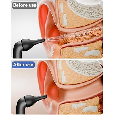 Electric Ear Wax Removal, Ear Cleaning Kit with Water Powered Ear Cleaner, Featuring 3 Pressure Settings and 12 Replacement Tips, Effective Ear Cleaning Tool