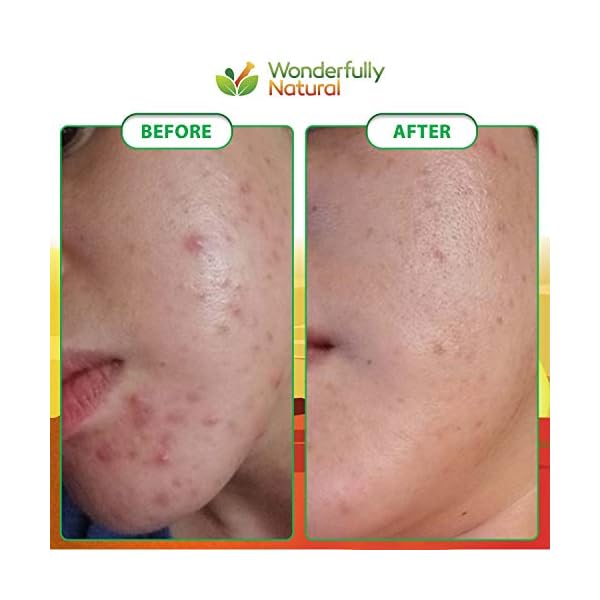 Organic African Black Soap - For Acne & Dark Spots | Natural Vegan and Cruelty Free â Satisfaction Guarantee 1lb bar | 90 day Supply