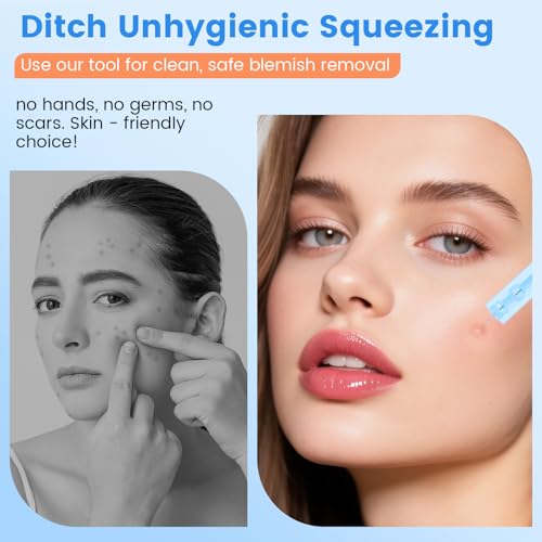 100er Pack Einweg Akne Pickel Nadeln, für Gesichtsfehler Schönheitssalon zu Hause