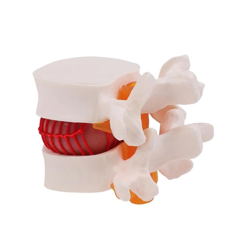 Image of Human Anatomical Lumbar Disc Herniation Model,1.5 Times Life Size Portable Lumbar Vertebrae Model ，Anatomy Medicine Teaching Tool for Medical Learning and Scientific Presentations