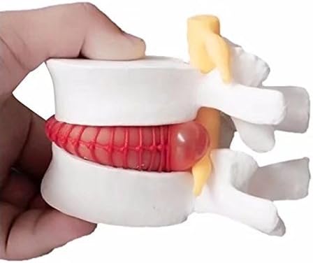 Lumbar Disc Herniation Spine Model - Magnification 1.5X Anatomical Human Lumbar Herniation Intervertebral Disc for School Teaching, Demonstrating, Lab Supplies