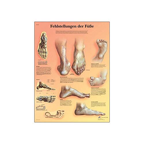 Image of 3B Scientific VR0185L Glossy UV Resistant Laminated Paper Fehlstellungen Der Fusse Anatomical Chart (Deformities of The Feet Anatomical Chart, German), Poster Size 20 inch Width x 26 inch Height