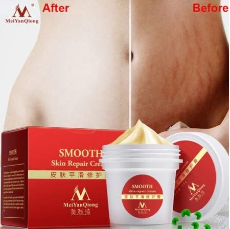 Removal Acne Scar Stretch Marks Cream Fat Scar Smooth Skin Cream Treatment Stretch Marks Remover for Women Maternity Cream 50g
