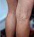 Verseo Vein Eraser - Varicose Veins Treatment for Legs - Varicose Veins Cream - Spider Vein Treatment for Legs - for Leg Veins, Varicose and Spider Veins & Rosacea - Full Results in Just 2 Months
