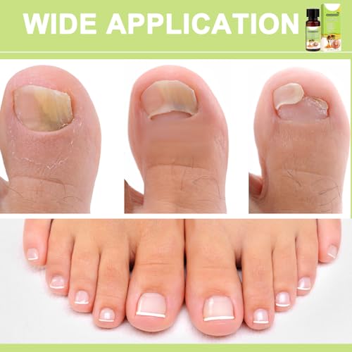 Bienengift Nagelserum, Furzero Bienengift Nagel, Furzero Bienengift Nagelserum, Furzero Nagelverteidigung Bienengift, Nagelwachstums- und Reparaturserum für Reparatur und Nagelwachstum