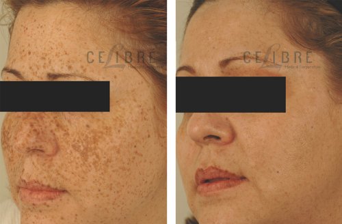 glutathione injections for sale in australia Medisco MesO Glutathione