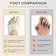 1 Paar Hallux Valgus Korrektur, Hallux Valgus Socken Ballenzehen Korrektur Rutschfester Fersenriemen Großer Zeh Hammerzeh Korrektur, Einstellbares Design Schiene Zehenkorrektur für Damen Herren(M)