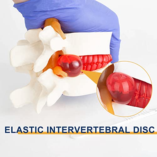 Image of Healthible Human Lumbar Disc Herniation Demonstration Model - Anatomical Lumbar Vertebral Model Disc Herniation Modelfor Education and Study