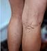 Verseo Vein Eraser - Varicose Veins Treatment for Legs - Varicose Veins Cream - Spider Vein Treatment for Legs - for Leg Veins, Varicose and Spider Veins & Rosacea - Full Results in Just 2 Months