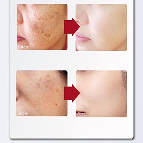 Blusoms Spotbanish Capsules Whitening Serum, Whitening Capsules Serum, Dark Spot Corrector Remover Serum, Whitening Moisturizer Face Cream Fade Fine Lines, Anti-Wrinkle, Whitening (2Pcs) #TOP4