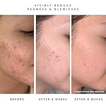 HERBIVORE Lapis Balancing Facial Oil with Blue Tansy + Squalane, Safe for Acne-Prone Skin | Helps Soothe Redness + Balance Oil Production, Lightweight, Non-Comedogenic, Plant-Based - Image 4