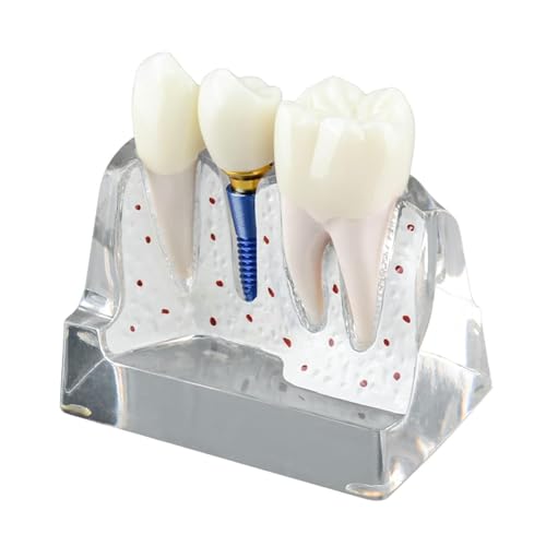 Hoite Zahnimplantatmodell, transparent, mit Harzkronen, Metallimplantaten, Abutments, trennbaren Teilen, 4 x Magnete, sichere Brücke