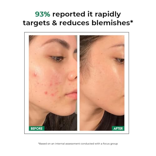 Image of Conscious Chemist Acne Care Duo | Spot Corrector Gel & Microneedle Acne Patches | Helps Improve Skin Clarity | With 2% Salicylic Acid, 2% Azelaic Acid & 3.3% Niacinamide | For Oily & Acne-Prone Skin | Pack of 2