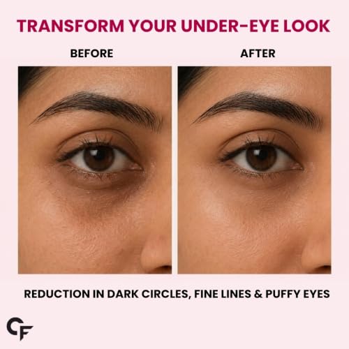Image of Carbamide Forte Hydrogel Under Eye Patches For Dark Circles | Under Eye Mask with Caffeine, Rose Extract, Niacinamide | Reduces Dark Circles & Puffiness | Hydrating & Brightening Eye Patches | 60 Patches (30 Pairs)