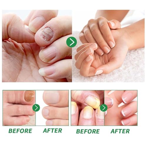 2PCS Ginger Nail Treatments,Nail Treatment,Ginger Nail Growth Serum - Image 4