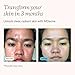 MDacne 3 Step Face Acne Treatment Kit, Benzoyl Peroxide Cream 2.5%, Salicylic Acid Cleanser, Niacinamide Moisturizer – Medicated Plant-Based Skincare for Adult & Teen Acne, 30 Day Kit