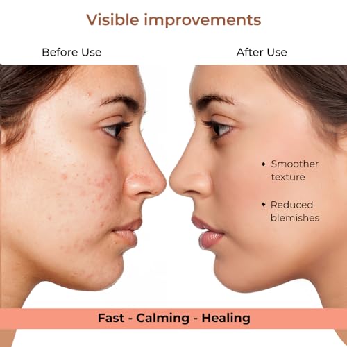 Image of bbold Microneedle Pimple Patches for face salicylic acid | Acne Remover Patch with Hyaluronic Acid Fights Acne from the Root & Reduces Acne Scarring - 9 Patches