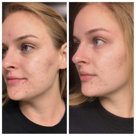 Natural Acne Cleanser - Gentle Face Wash To Clear And Control Acne Prone Skin - Tea Tree Oil, Aloe Vera & Gentle Essential Oils For A Refreshing Deep Clean - For Teens And Adults By Keeva Organics #TOP5