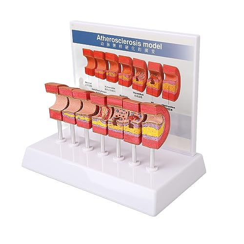 Image of 7PCS Artery Anatomy Model with Atherosclerosis Thrombus Vascular Model for Doctors, Educational Tool