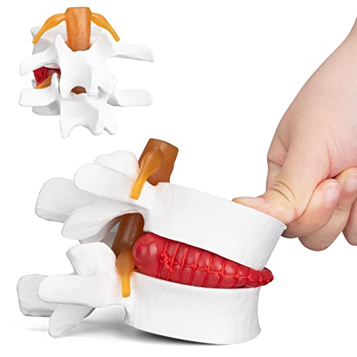 Image of ANNWAN Disc Herniation Model - Human Lumbar Disc Herniation Spine Model Vertebrae Disc Model for Teaching and Studying