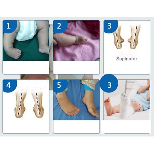 Attelle pied tombant pour enfant et nourrisson | Correction varus 10cm - 6