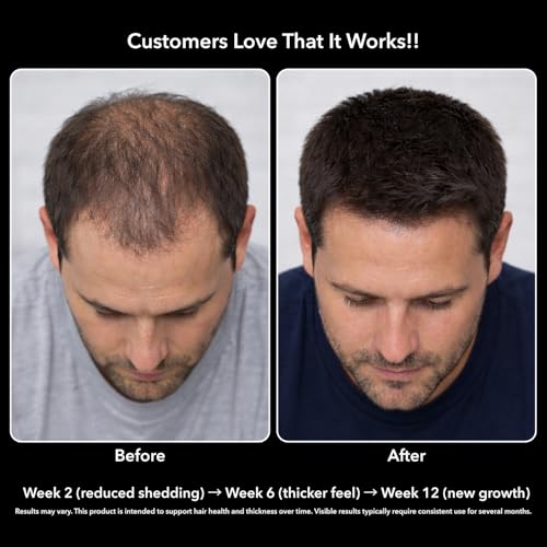 Image of DHT Blocker for Men with Biotin 10000mcg Per Serving, Saw Palmetto Extract & MSM - Supports Normal Healthy Hair Growth - With Pea Extract & Stinging Nettle - Vegan, Non-GMO, Gluten Free - 30 Servings