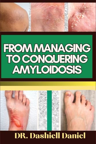 FROM MANAGING TO CONQUERING AMYLOIDOSIS: Expert Guide To Understanding Amyloidosis Causes, Symptoms, Preventing, Treatment For Optimal Wellness
