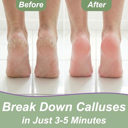 Image of Callus Remover for Feet (Extra Strength 8 oz) Foot Callus Remover Gel, Spa Foot Care, Pedicure Tools for Feet Scrubber