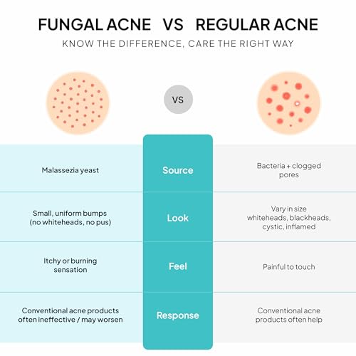 Image of BellamiLuxx Fungal Acne Treatment Lotion: Effective Face & Body Pimple Cream for Bumps, Clusters, Itch & Redness - Fungal Prone Skin Acne Treatment Moisturizer for Teens & Adults with Natural Actives