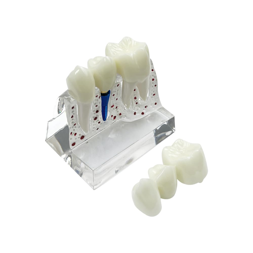SENLIN DENTAL 4 Times Teeth Implant Models, Dental Model for Patient Education and Class Studying Teeth Model, Dental Implant, Crown and Bridge Model for Presentation (White)