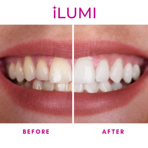 iLUMI at Home Teeth Whitening System - Harvard Doctor Approved - 10 Min Non-Sensitive Fast Results, (3) Carbamide Peroxide Gel, (1) Desensitizing Gel (Pink)
