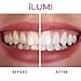 iLUMI at Home Teeth Whitening System - Harvard Doctor Approved - 10 Min Non-Sensitive Fast Results, (3) Carbamide Peroxide Gel, (1) Desensitizing Gel (Pink)