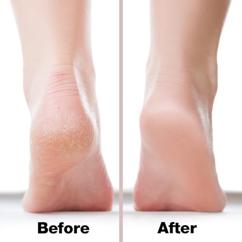 Image of Probelle Double Sided Multidirectional Nickel Foot File Callus Remover - Immediately Reduces calluses and Corns to Powder for Instant Results, Safe Tool (Pink)