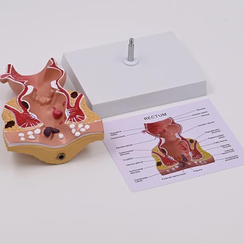 Human Rectum Model for Lab School Human Pathologies of Rectum Model Human Anatomy Model Medicals Teaching Tool - Thumbnail 5