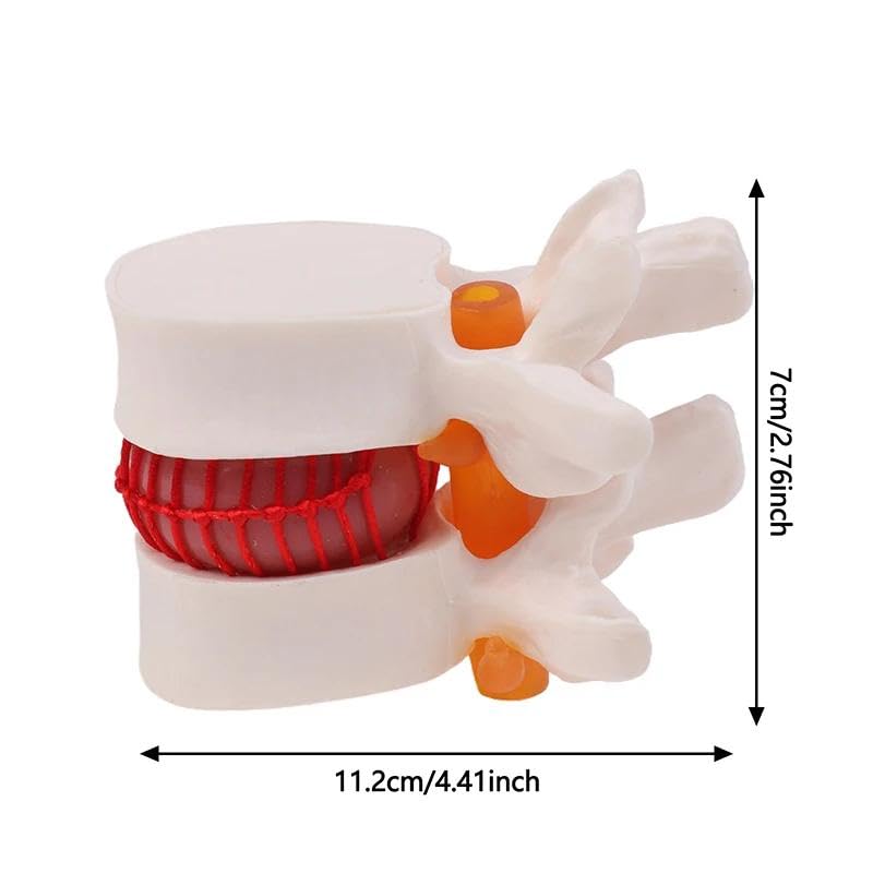 Image of Human Anatomical Lumbar Disc Herniation Model,1.5 Times Life Size Portable Lumbar Vertebrae Model ，Anatomy Medicine Teaching Tool for Medical Learning and Scientific Presentations