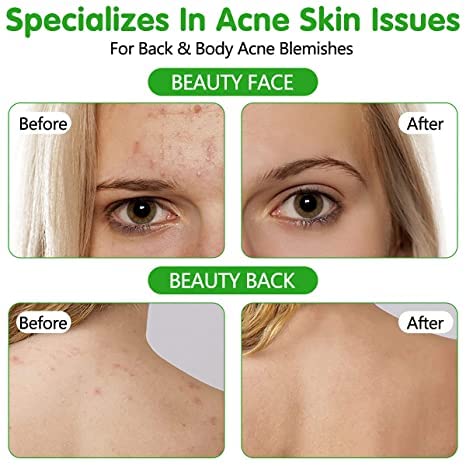 Aerosol para el acné, tratamiento para el acné, cuerpo, espalda, cara, pecho, cuidado de la piel, contiene aceite orgánico natural de árbol de té para que la piel pase los puntos curativos del acné, equilibrio e hidratante, 4.3 onzas 3