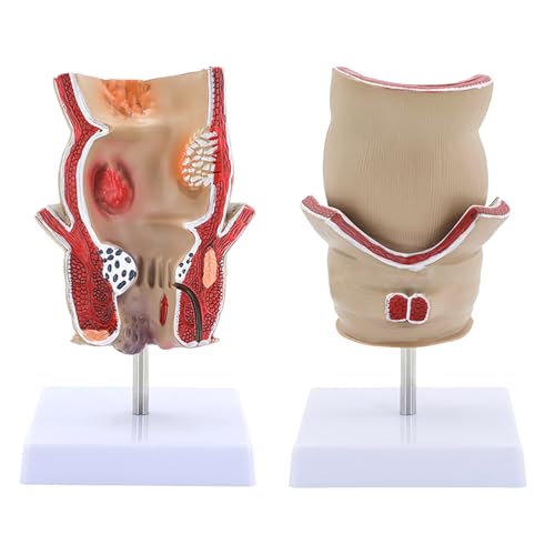 Modèle rectum humain pour l'anatomie et l'explication clinique - 7