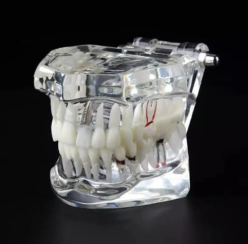 Dental All In One Study Model (Feature - Dental implants, Crown and bridge, Implant-supported bridge, Tooth avulsion, Abfraction Root canal Caries Periapical)