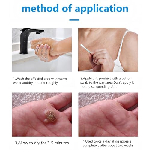 Crema eliminadora de verrugas 20g, eficaz para congelar verrugas, plantas de los pies, verrugas comunes, verrugas planas, callos, durezas, apta para manos, pies y espalda
