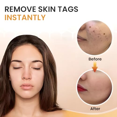 Image of Skin Tag & Mole Remover Serum - Quick-Acting Natural Formula for Face and Body - Simple to Use, 30ML