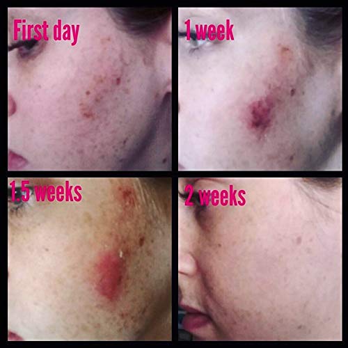 2 Hydroquinone Dark Spot Corrector Remover For Face & Melasma