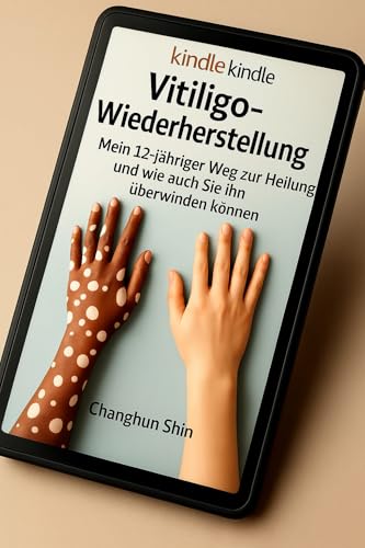 VITILIGO-WIEDERHERSTELLUNG: Mein 12-jähriger Weg zur Heilung und wie auch Sie ihn überwinden können (German Edition)