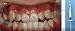 1 Kit OrthoForce Self-cure Adhesivo Cemento Dental Ortodoncia Dental Metal Brace