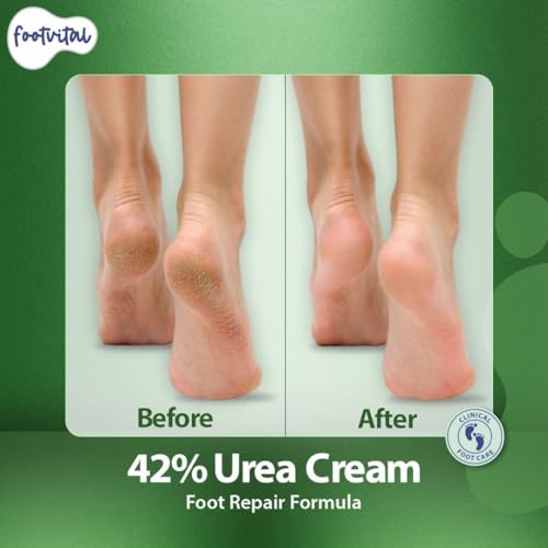 Image of Footvital 42% Urea Cream for cracked heels with 2% Salicylic Acid 200 g | intensive foot repair formula | skin-friendly | dermatologist-approved