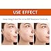 YAFUSIPE Acne Treatment for Face for Hormonal Cystic Stubborn Acne Cream for Sensitive Skin Teens Adults Women Men Spot Pimple Butt Control Rapid Clearing Breakout Overnight Face Blemish Treatment