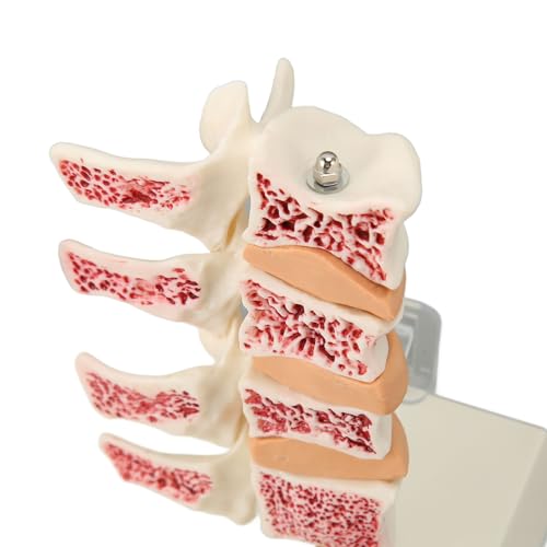 Image of ZJchao Osteoporosis Spine Model, ABS Anatomical Osteoporosis Model, Pathological Changes Visualization Versatile Learning Tool for Anatomy Education Constructed